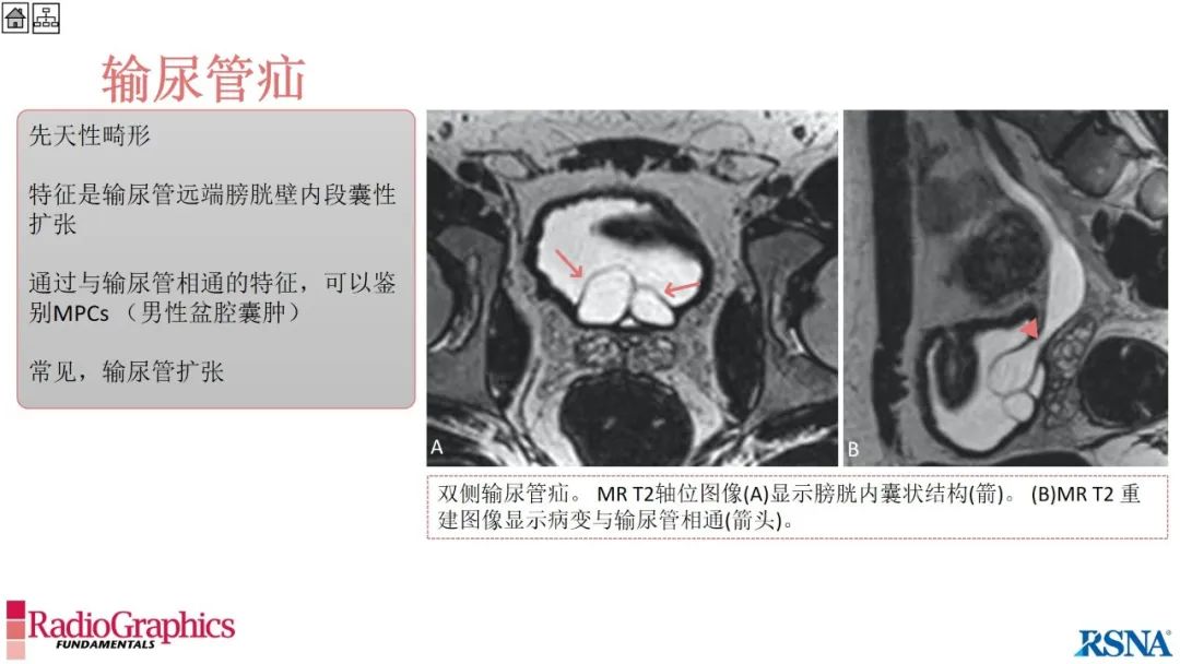 影像PPT - 【PPT】男性盆腔囊肿的影像诊断方法-92