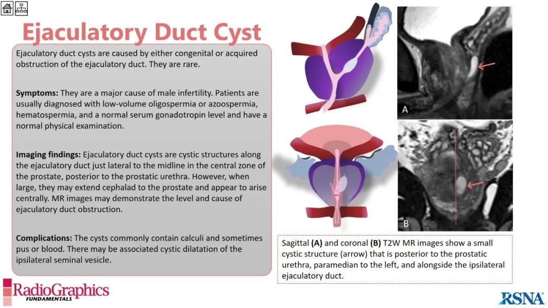 影像PPT - 【PPT】男性盆腔囊肿的影像诊断方法-53