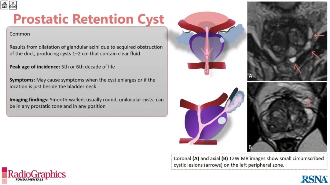 影像PPT - 【PPT】男性盆腔囊肿的影像诊断方法-69