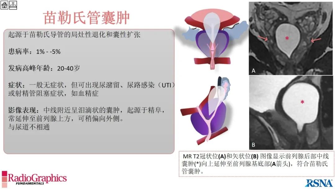 影像PPT - 【PPT】男性盆腔囊肿的影像诊断方法-48