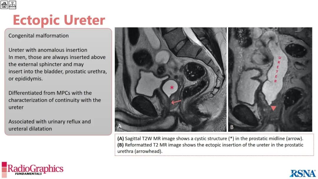 影像PPT - 【PPT】男性盆腔囊肿的影像诊断方法-95