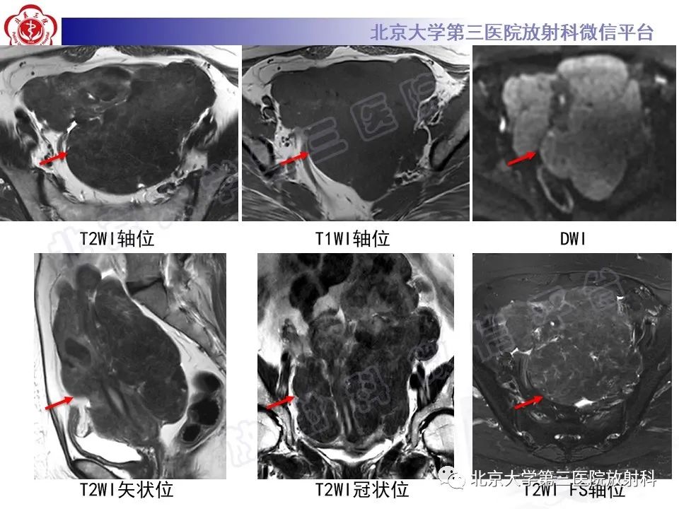 影像PPT - 【PPT】静脉内平滑肌瘤病-4