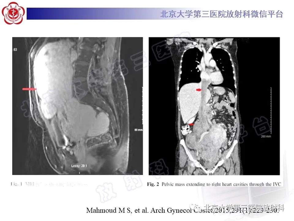 影像PPT - 【PPT】静脉内平滑肌瘤病-22