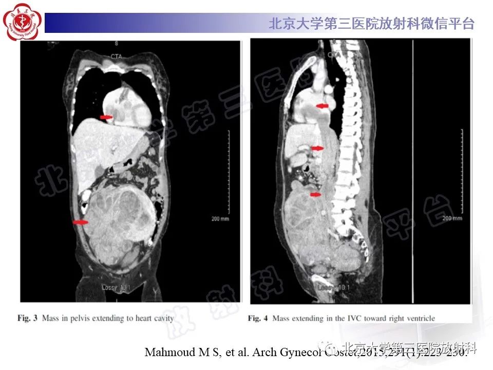 影像PPT - 【PPT】静脉内平滑肌瘤病-23