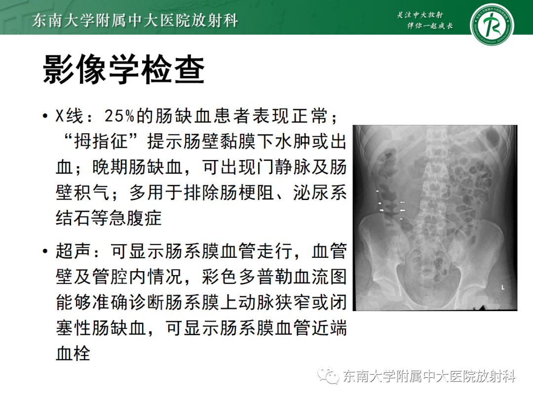 影像PPT - 【PPT】急性肠系膜缺血-9 影像PPT - 【PPT】急性肠系膜缺血-9