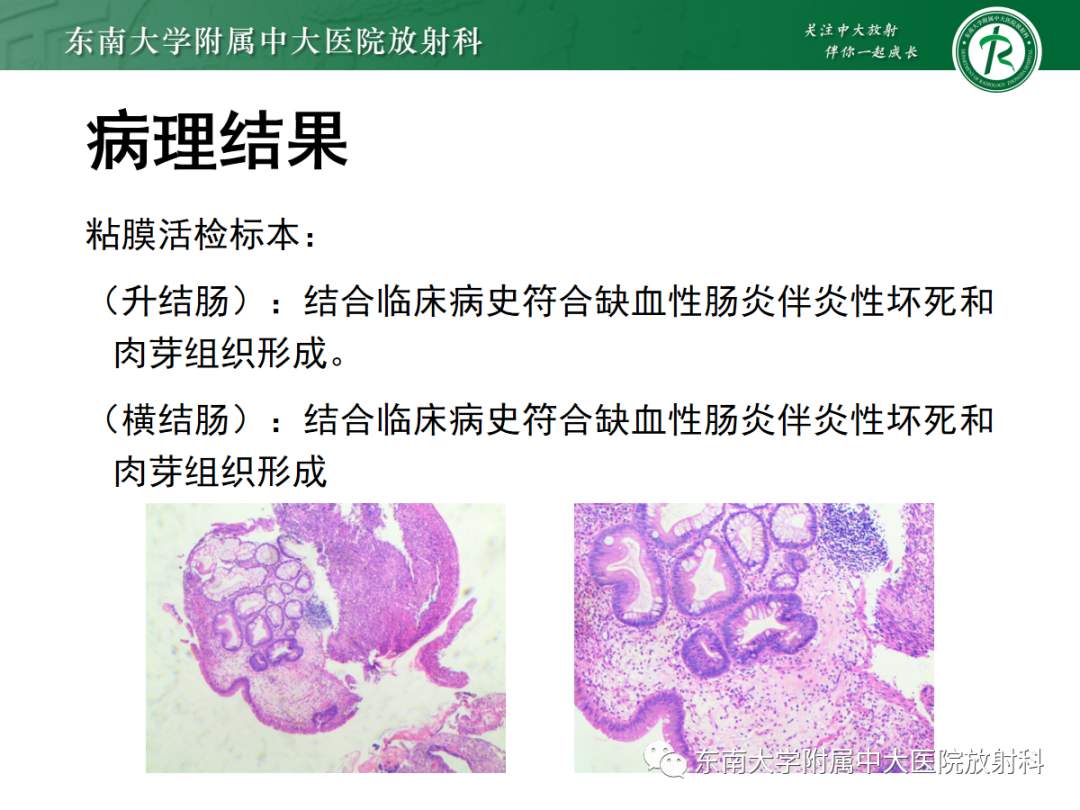 影像PPT - 【PPT】急性肠系膜缺血-2 影像PPT - 【PPT】急性肠系膜缺血-2