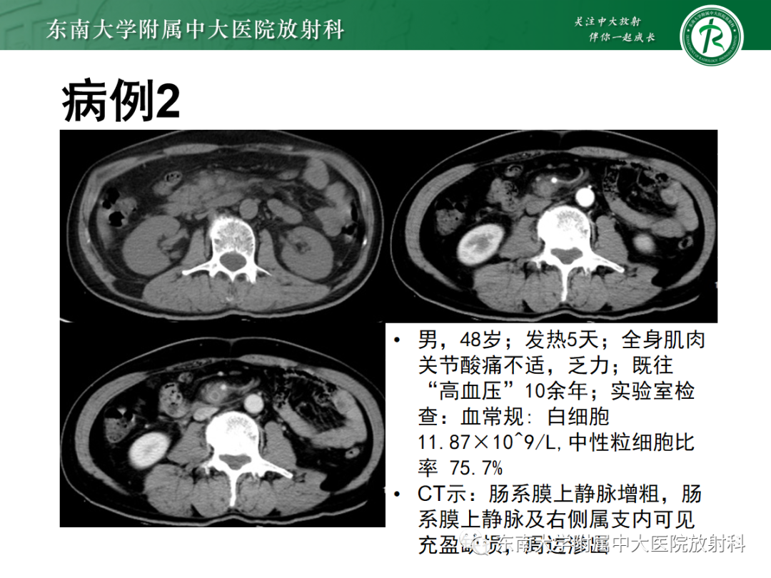 影像PPT - 【PPT】急性肠系膜缺血-16 影像PPT - 【PPT】急性肠系膜缺血-16