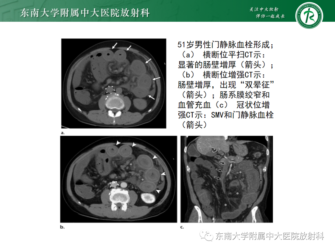 影像PPT - 【PPT】急性肠系膜缺血-14 影像PPT - 【PPT】急性肠系膜缺血-14
