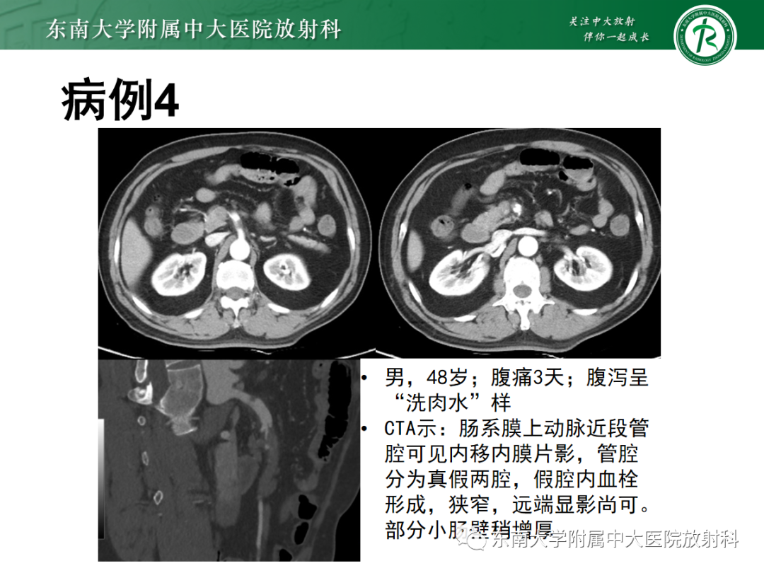 影像PPT - 【PPT】急性肠系膜缺血-21 影像PPT - 【PPT】急性肠系膜缺血-21