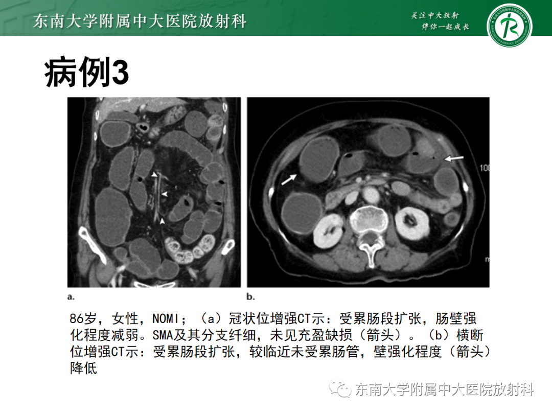 影像PPT - 【PPT】急性肠系膜缺血-17 影像PPT - 【PPT】急性肠系膜缺血-17