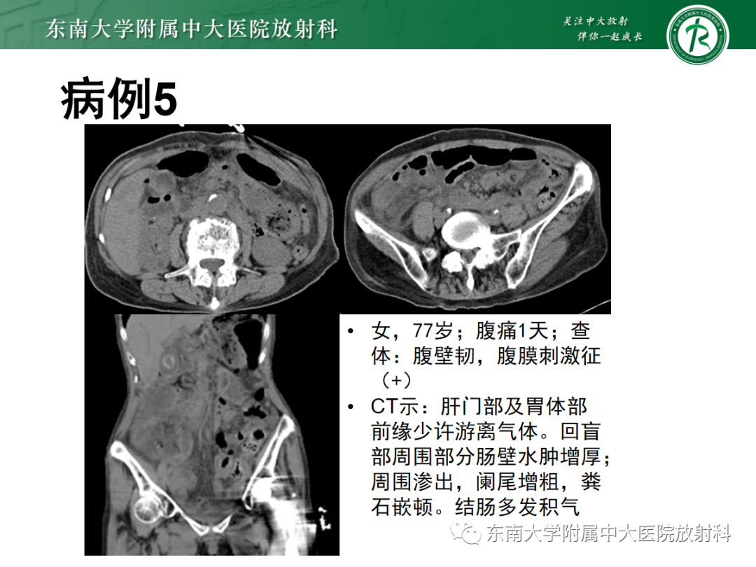 影像PPT - 【PPT】急性肠系膜缺血-24 影像PPT - 【PPT】急性肠系膜缺血-24