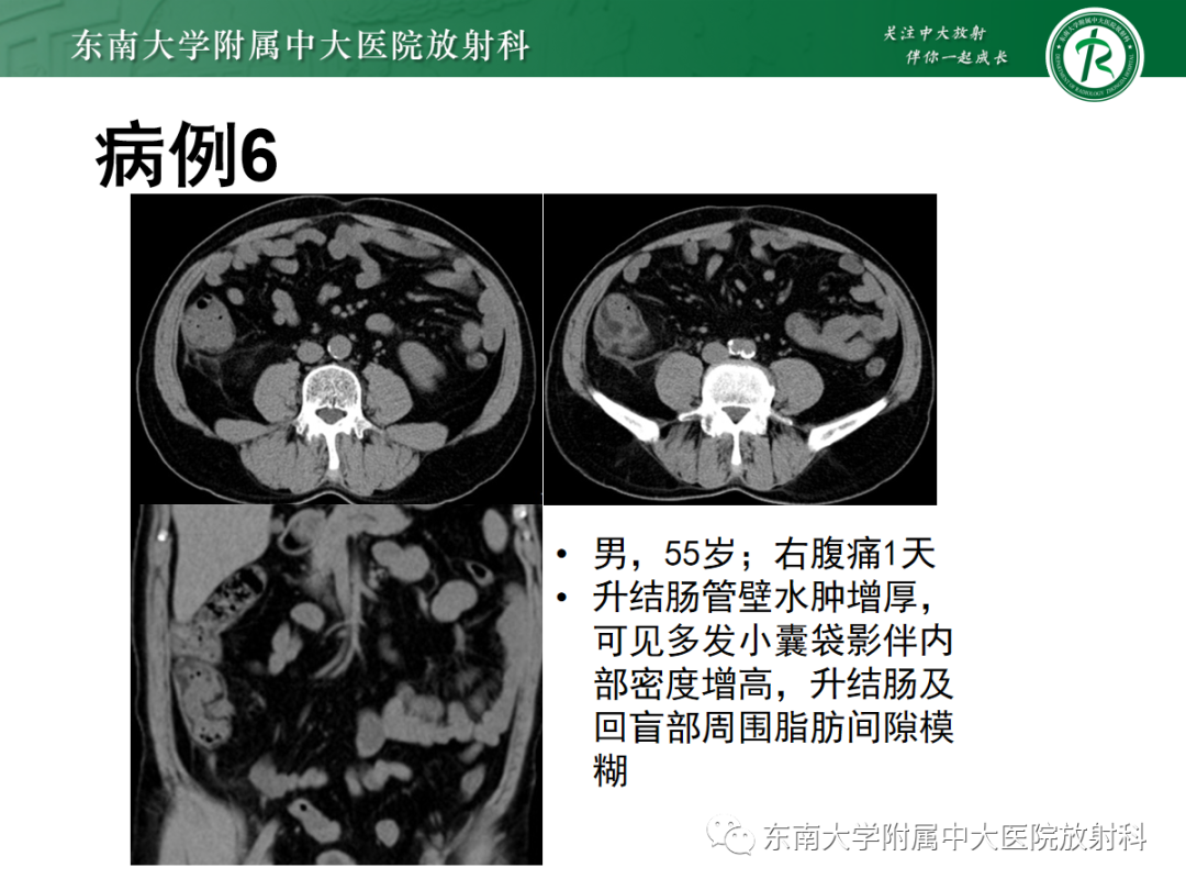 影像PPT - 【PPT】急性肠系膜缺血-26 影像PPT - 【PPT】急性肠系膜缺血-26