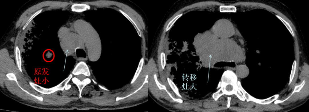 影像PPT - 中央型小细胞肺癌CT与病理对照-29 影像PPT - 中央型小细胞肺癌CT与病理对照-29