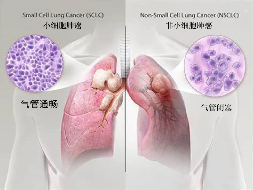 影像PPT - 中央型小细胞肺癌CT与病理对照-16 影像PPT - 中央型小细胞肺癌CT与病理对照-16