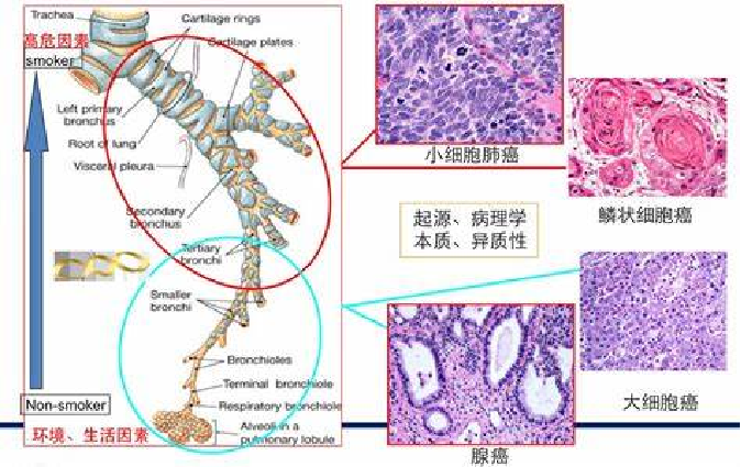 影像PPT - 中央型小细胞肺癌CT与病理对照-13 影像PPT - 中央型小细胞肺癌CT与病理对照-13