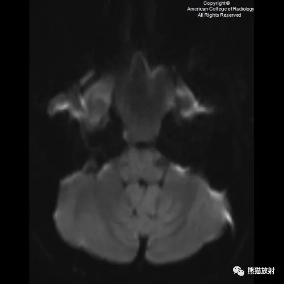 影像PPT - 【病例】鼻窦粘液囊肿1例MR影像-6 影像PPT - 【病例】鼻窦粘液囊肿1例MR影像-6