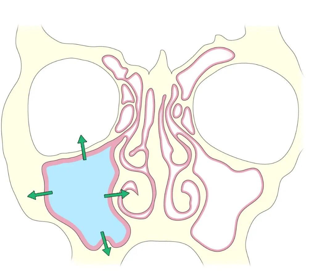 影像PPT - 【病例】鼻窦粘液囊肿1例MR影像-10 影像PPT - 【病例】鼻窦粘液囊肿1例MR影像-10