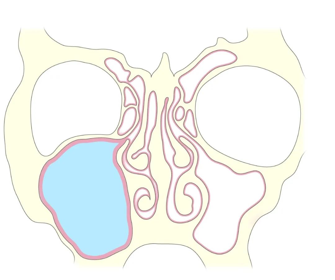 影像PPT - 【病例】鼻窦粘液囊肿1例MR影像-11 影像PPT - 【病例】鼻窦粘液囊肿1例MR影像-11