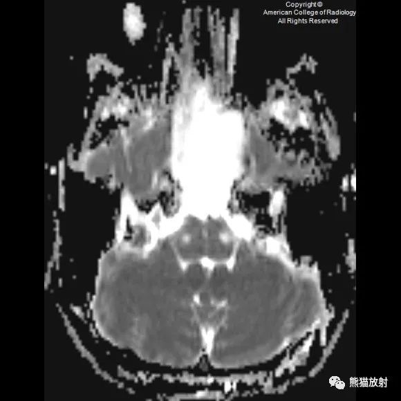 影像PPT - 【病例】鼻窦粘液囊肿1例MR影像-7 影像PPT - 【病例】鼻窦粘液囊肿1例MR影像-7