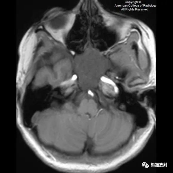 影像PPT - 【病例】鼻窦粘液囊肿1例MR影像-4 影像PPT - 【病例】鼻窦粘液囊肿1例MR影像-4