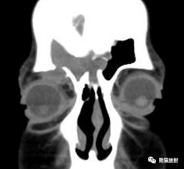 影像PPT - 【病例】鼻窦粘液囊肿1例MR影像-19 影像PPT - 【病例】鼻窦粘液囊肿1例MR影像-19