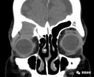 影像PPT - 【病例】鼻窦粘液囊肿1例MR影像-20 影像PPT - 【病例】鼻窦粘液囊肿1例MR影像-20