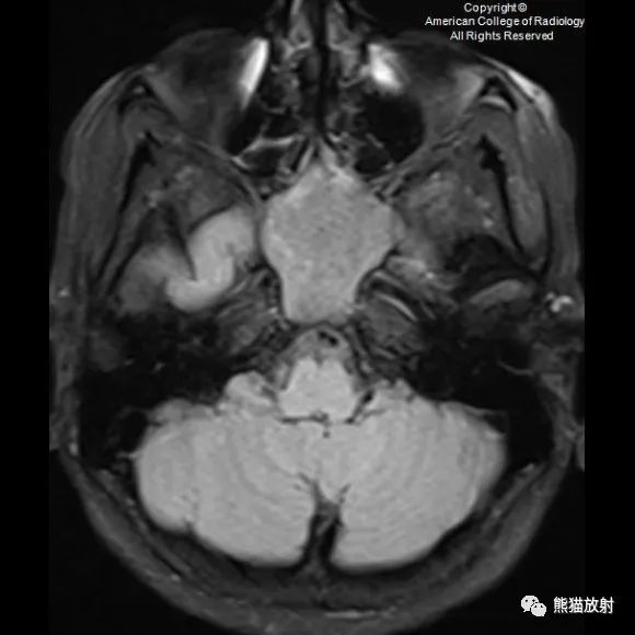 影像PPT - 【病例】鼻窦粘液囊肿1例MR影像-2 影像PPT - 【病例】鼻窦粘液囊肿1例MR影像-2