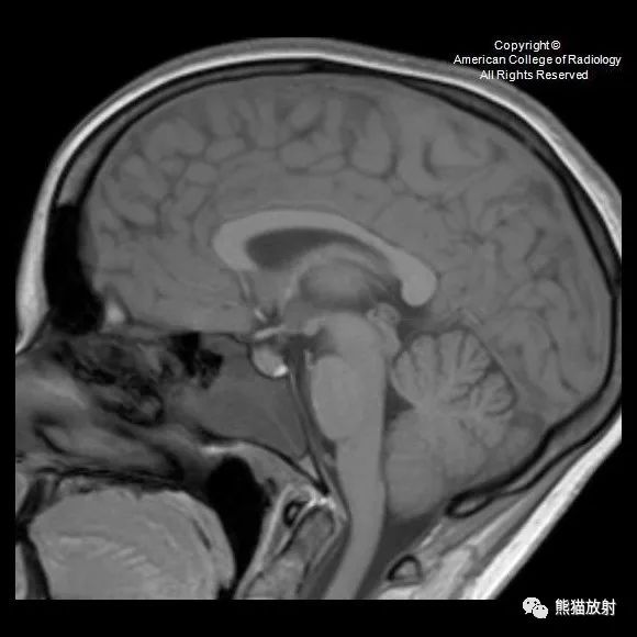 影像PPT - 【病例】鼻窦粘液囊肿1例MR影像-3 影像PPT - 【病例】鼻窦粘液囊肿1例MR影像-3