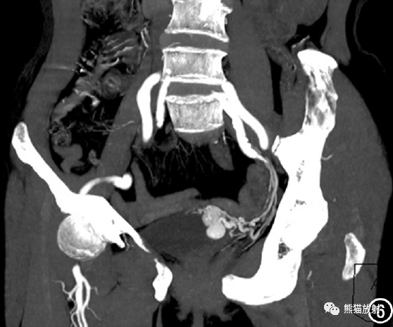 影像PPT - 【病例】膀胱副神经节瘤合并动脉瘤1例CT影像-6 影像PPT - 【病例】膀胱副神经节瘤合并动脉瘤1例CT影像-6