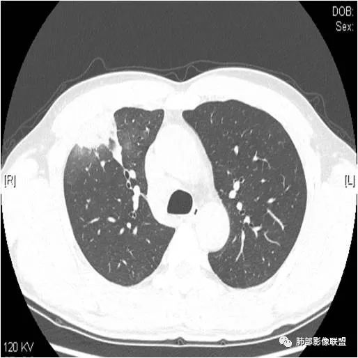 影像PPT - 【病例】肺炎性实变影的分析思路-11 影像PPT - 【病例】肺炎性实变影的分析思路-11