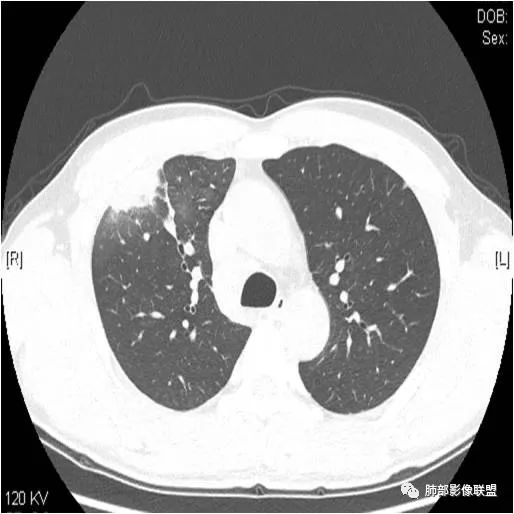 影像PPT - 【病例】肺炎性实变影的分析思路-10 影像PPT - 【病例】肺炎性实变影的分析思路-10