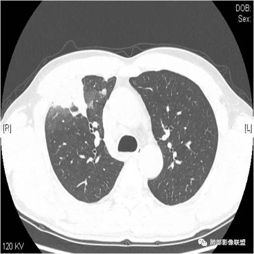 影像PPT - 【病例】肺炎性实变影的分析思路-13 影像PPT - 【病例】肺炎性实变影的分析思路-13