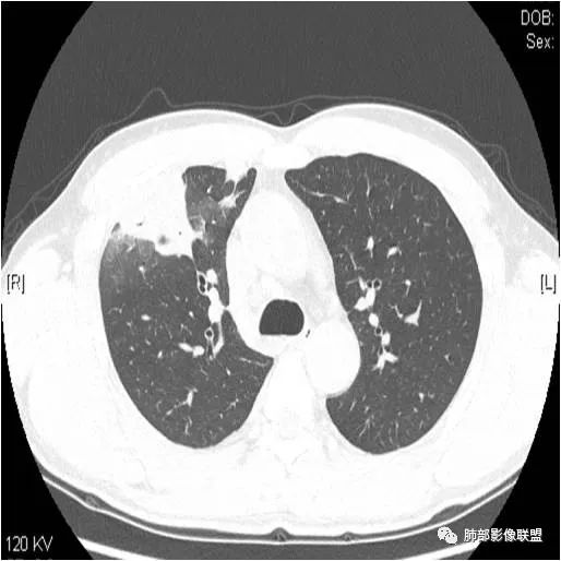 影像PPT - 【病例】肺炎性实变影的分析思路-14 影像PPT - 【病例】肺炎性实变影的分析思路-14