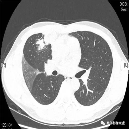 影像PPT - 【病例】肺炎性实变影的分析思路-47 影像PPT - 【病例】肺炎性实变影的分析思路-47