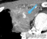 影像PPT - 【病例】肺炎性实变影的分析思路-69 影像PPT - 【病例】肺炎性实变影的分析思路-69
