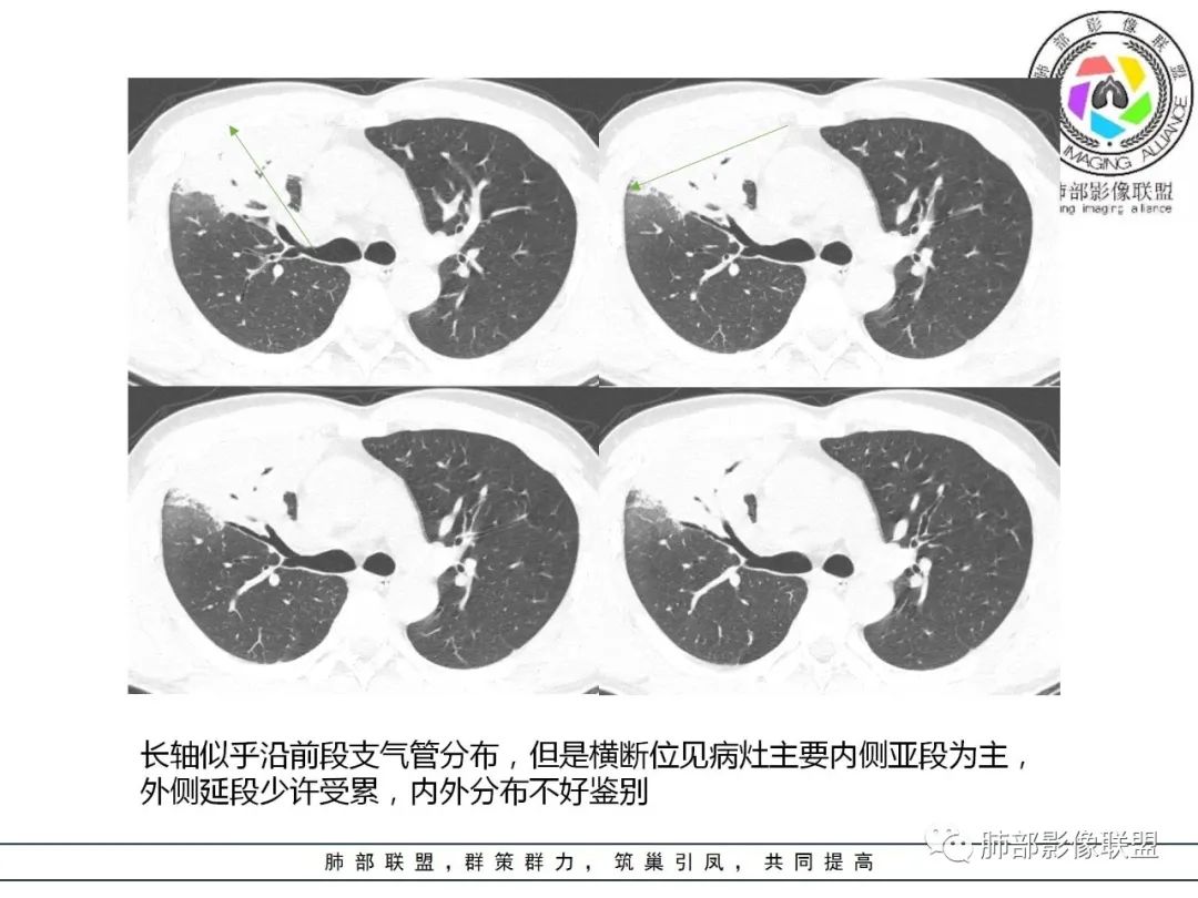 影像PPT - 【病例】肺炎性实变影的分析思路-70 影像PPT - 【病例】肺炎性实变影的分析思路-70