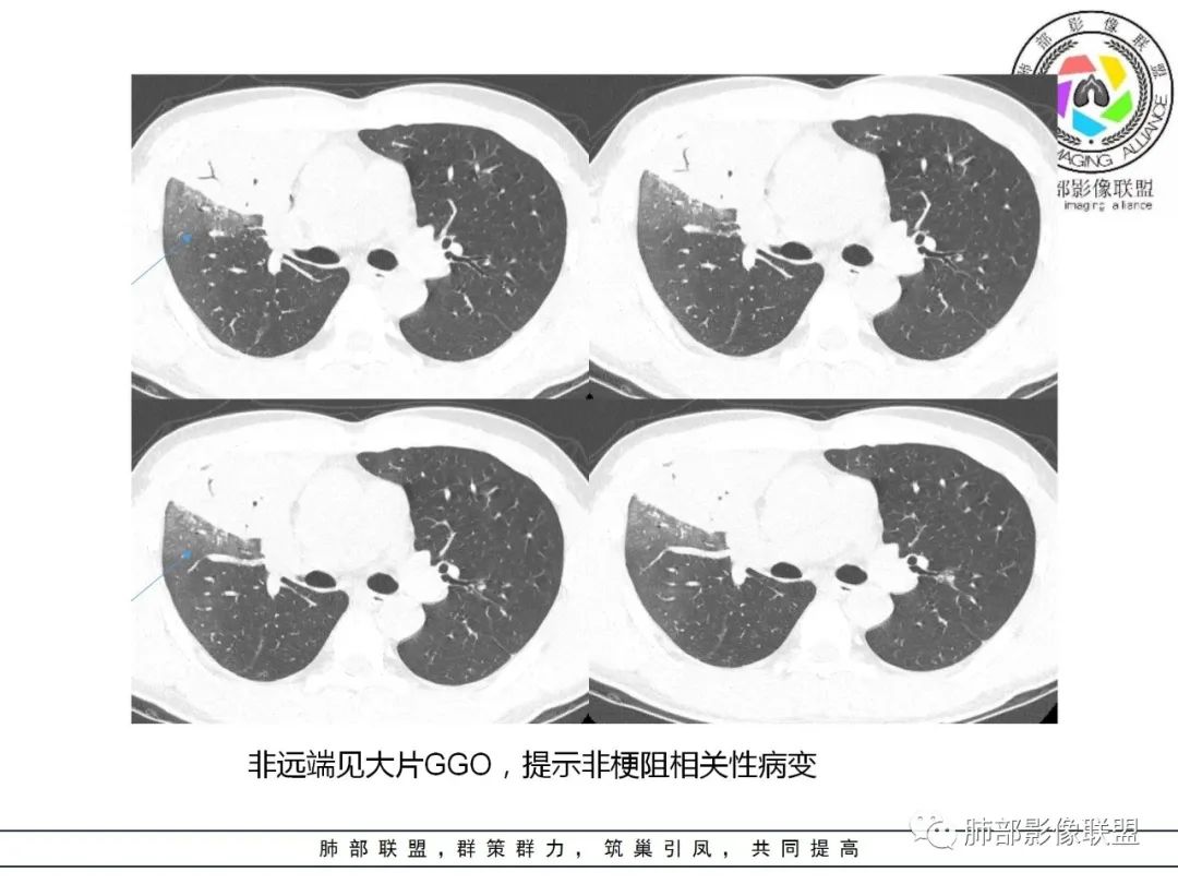 影像PPT - 【病例】肺炎性实变影的分析思路-71 影像PPT - 【病例】肺炎性实变影的分析思路-71