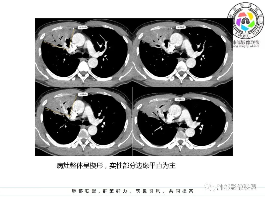 影像PPT - 【病例】肺炎性实变影的分析思路-72 影像PPT - 【病例】肺炎性实变影的分析思路-72
