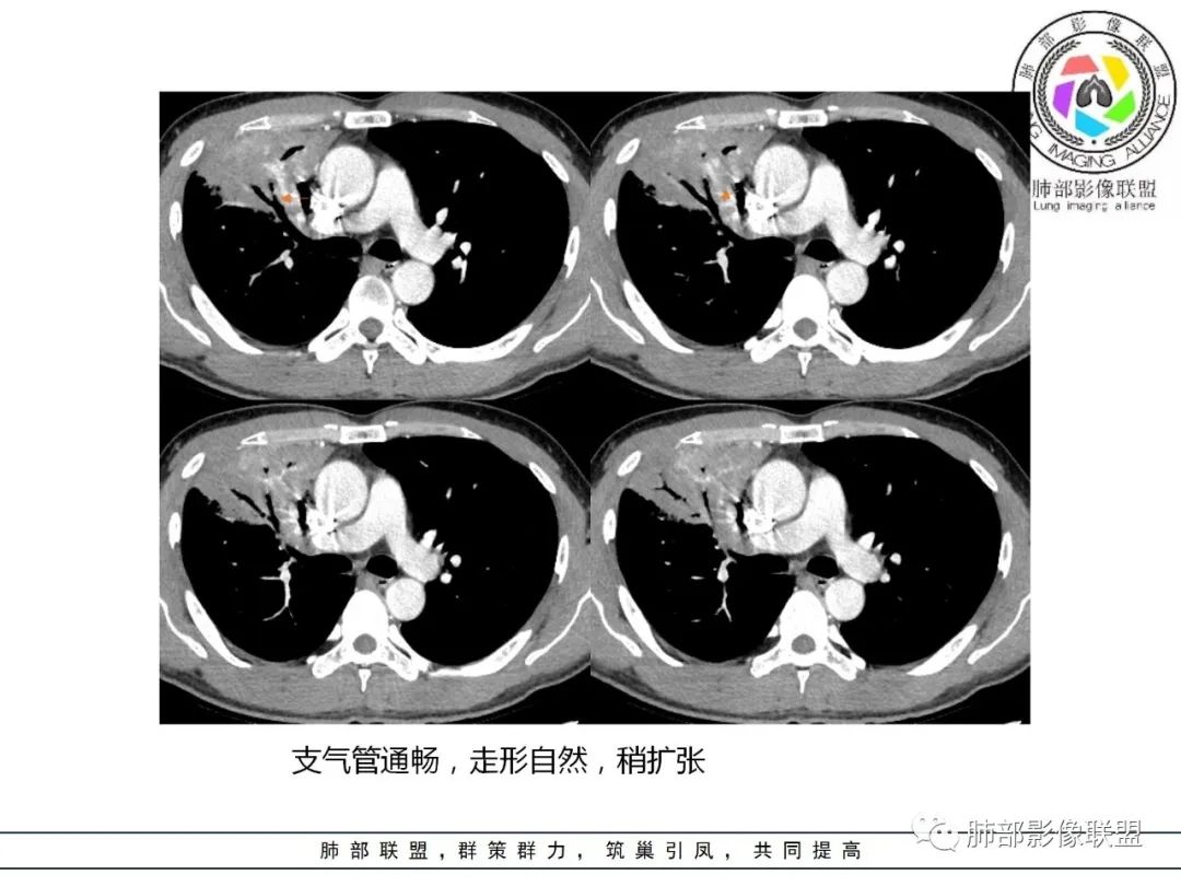 影像PPT - 【病例】肺炎性实变影的分析思路-73 影像PPT - 【病例】肺炎性实变影的分析思路-73