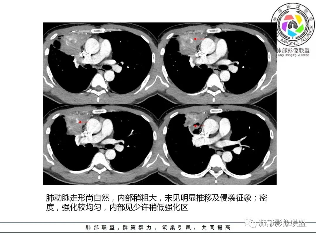 影像PPT - 【病例】肺炎性实变影的分析思路-74 影像PPT - 【病例】肺炎性实变影的分析思路-74