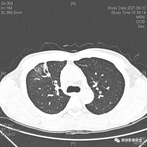 影像PPT - 【病例】肺炎性实变影的分析思路-78 影像PPT - 【病例】肺炎性实变影的分析思路-78
