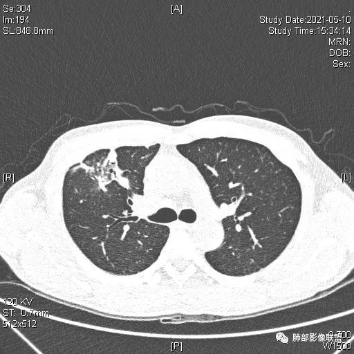 影像PPT - 【病例】肺炎性实变影的分析思路-79 影像PPT - 【病例】肺炎性实变影的分析思路-79
