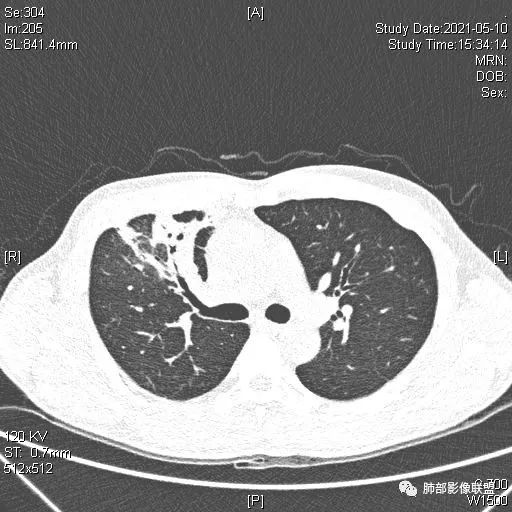 影像PPT - 【病例】肺炎性实变影的分析思路-80 影像PPT - 【病例】肺炎性实变影的分析思路-80
