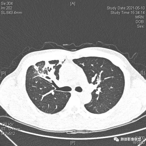 影像PPT - 【病例】肺炎性实变影的分析思路-81 影像PPT - 【病例】肺炎性实变影的分析思路-81