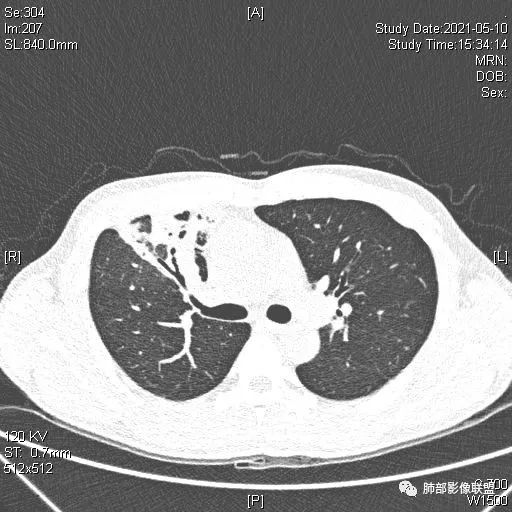 影像PPT - 【病例】肺炎性实变影的分析思路-82 影像PPT - 【病例】肺炎性实变影的分析思路-82