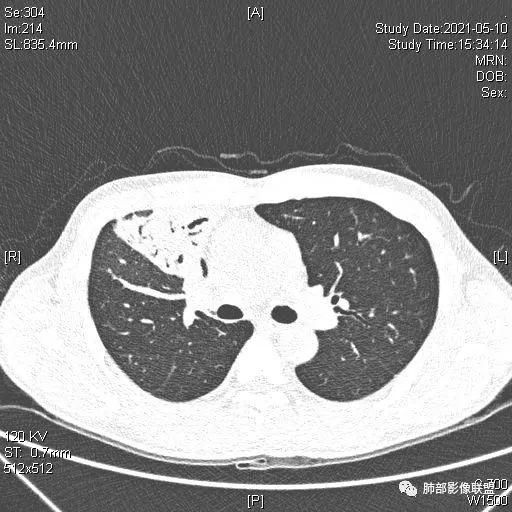 影像PPT - 【病例】肺炎性实变影的分析思路-83 影像PPT - 【病例】肺炎性实变影的分析思路-83