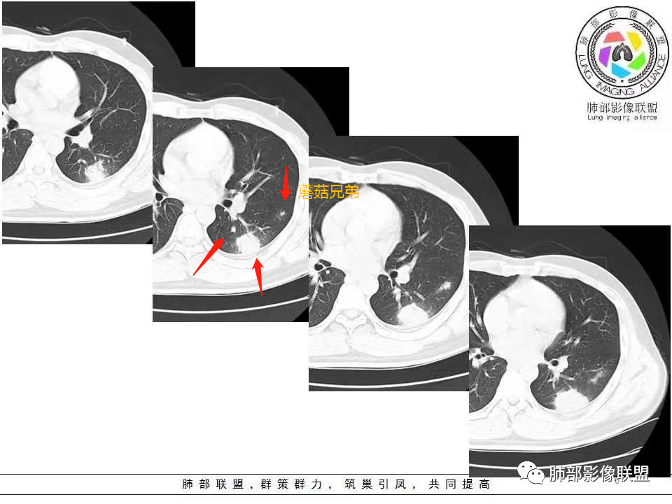 影像PPT - 【病例】肺炎性实变影的分析思路-84 影像PPT - 【病例】肺炎性实变影的分析思路-84