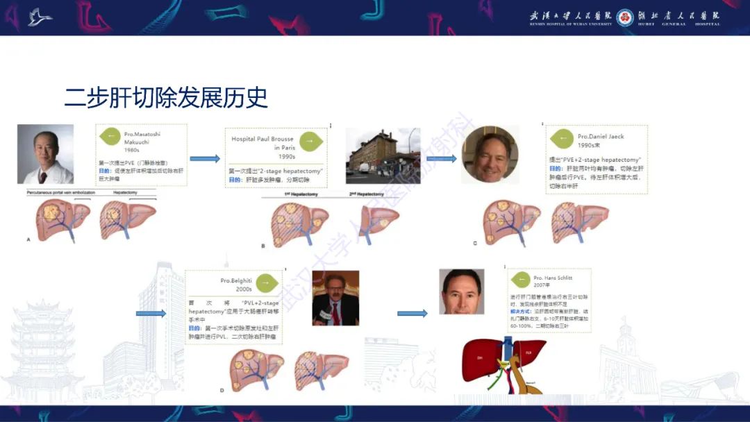 影像PPT - 【PPT】二步肝切除术CT评估-4