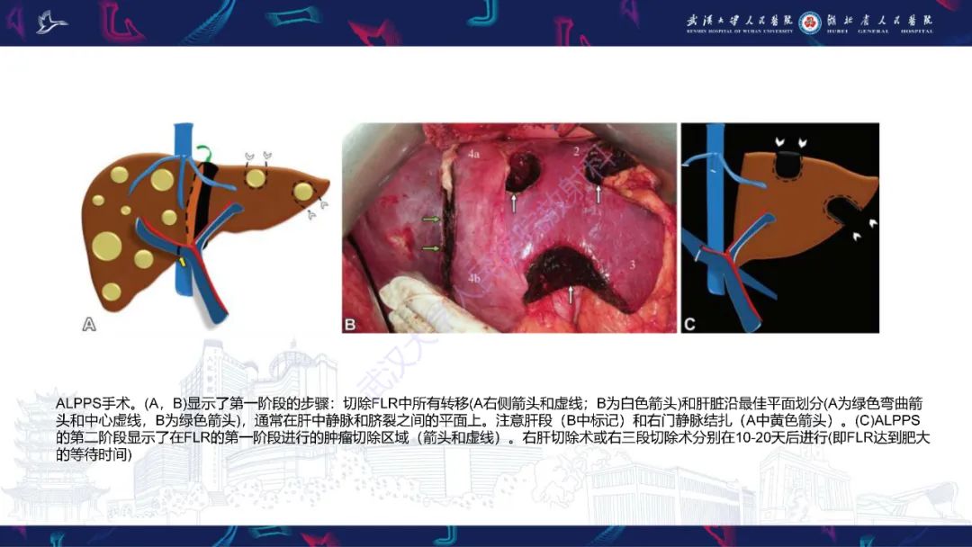影像PPT - 【PPT】二步肝切除术CT评估-10