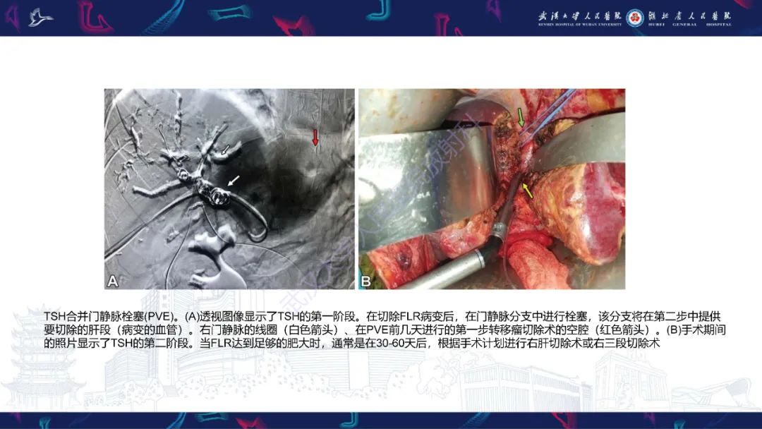 影像PPT - 【PPT】二步肝切除术CT评估-9